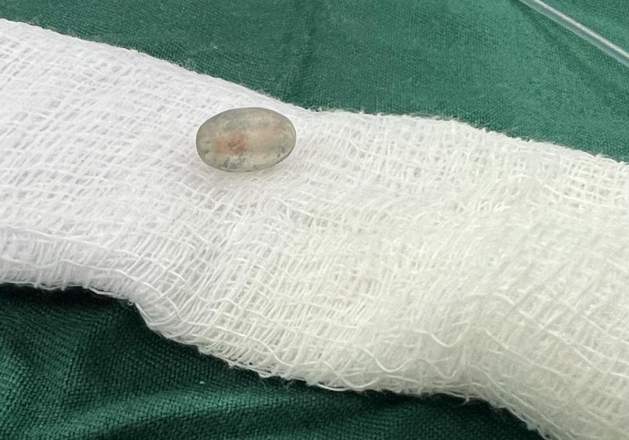 被取出的異物。中國援桑醫(yī)療隊供圖